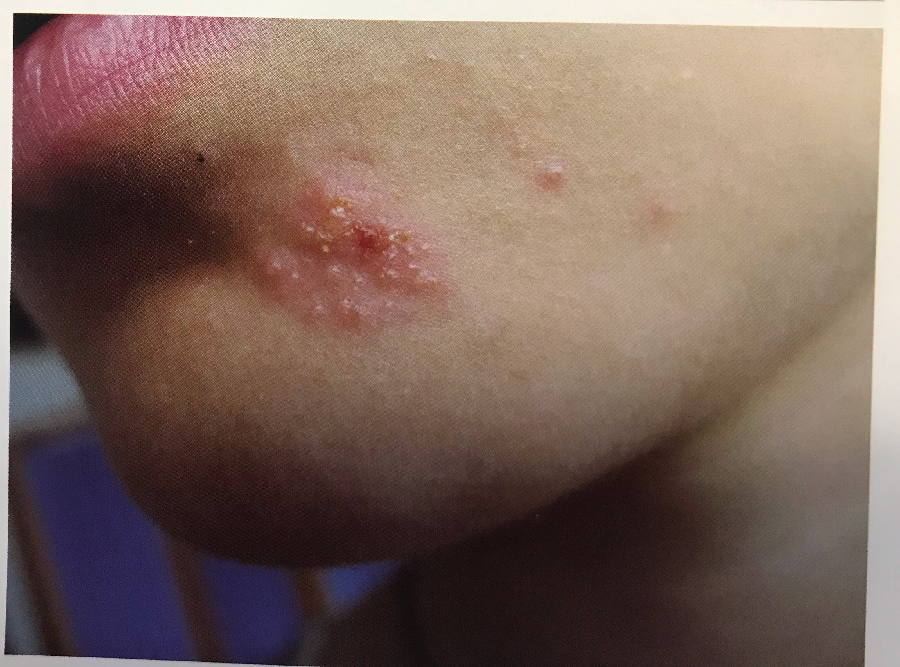 汗疱疹与水疱型手癣区别图_腿上水泡型疱疹图片_疱疹和上火水泡的区别图