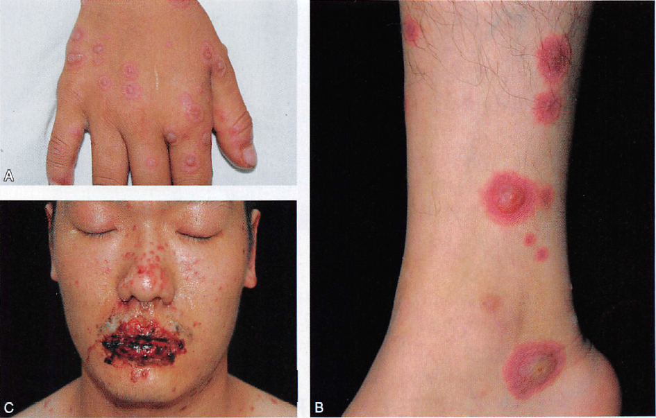 多形红斑也称多形渗出性红斑,是一种病因复杂的急性炎症性皮肤病.
