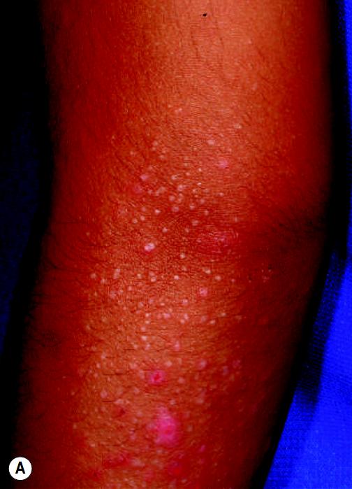 沙土性皮炎:手背上的苔藓样丘疹图片来源:刘欣