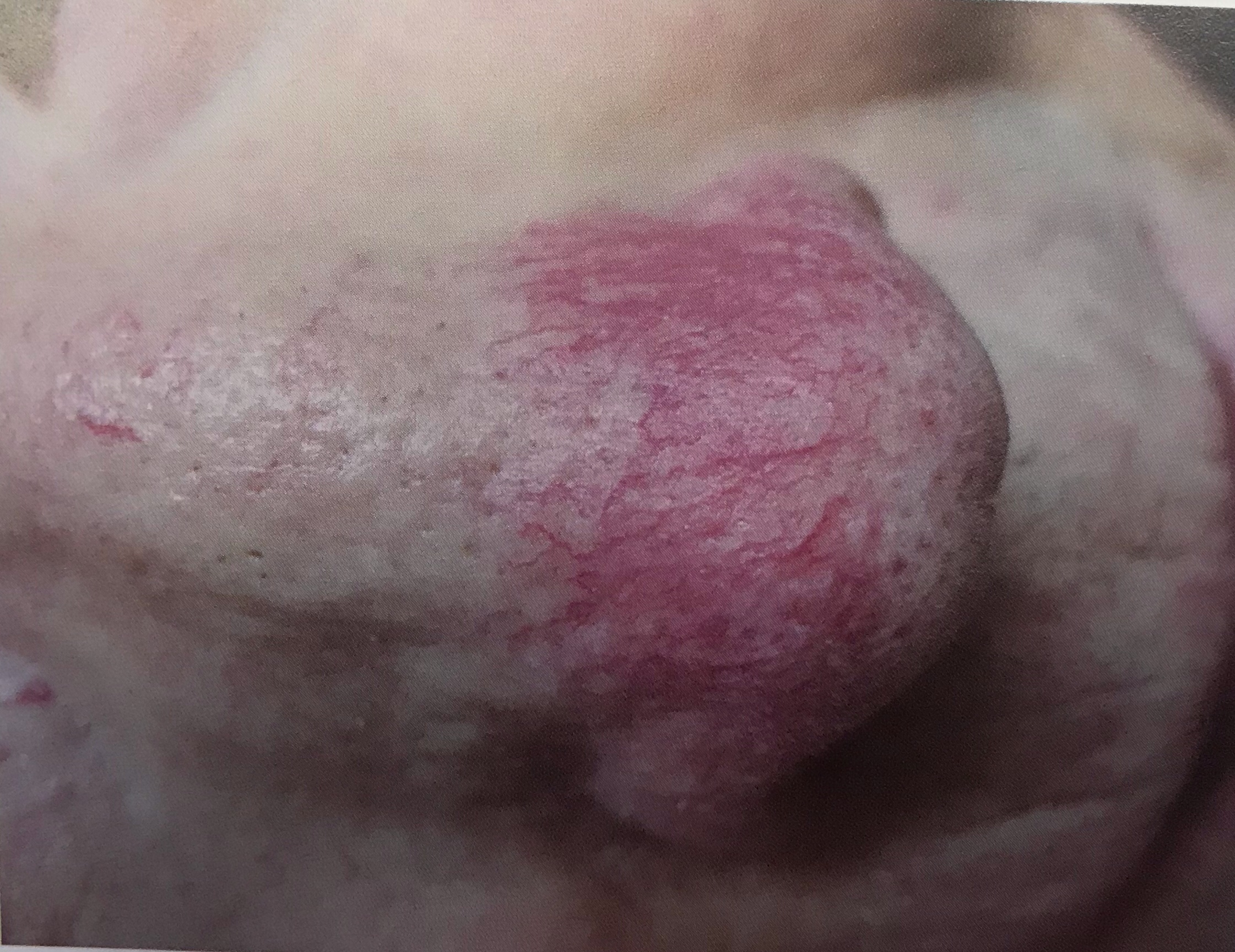玫瑰痤疮-红斑期.jpg
