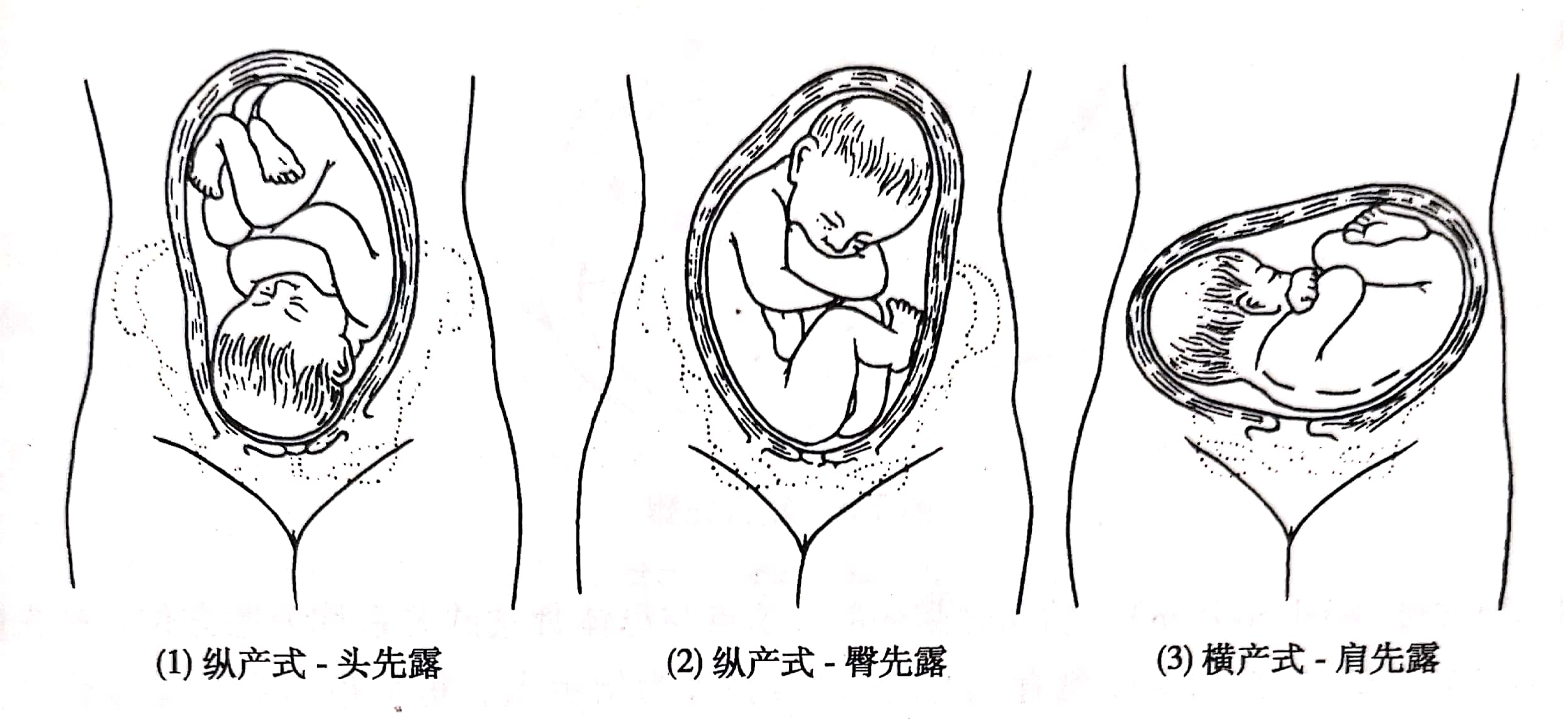 胎体纵轴与母体纵轴平行者,称为纵产式,占足月妊娠分娩总数的 9975%