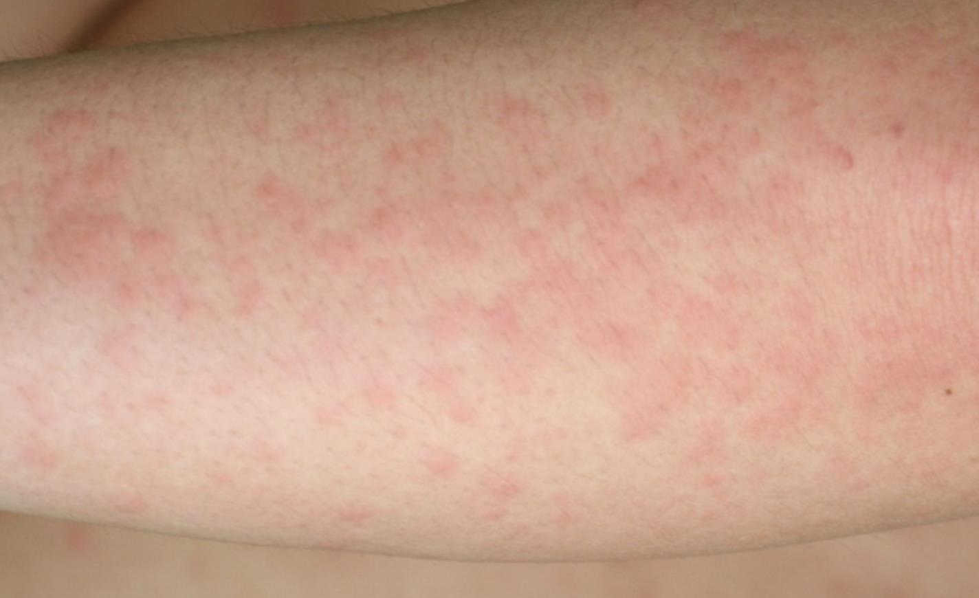 胆碱性荨麻疹初期图片图片