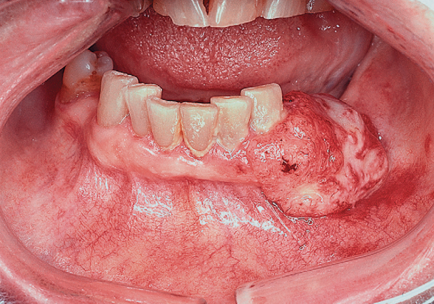 牙龈癌图片 菜花图片