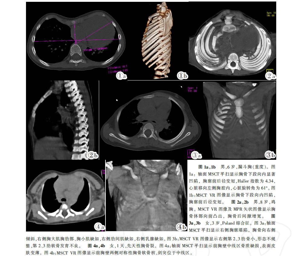 漏斗胸ct图片图片