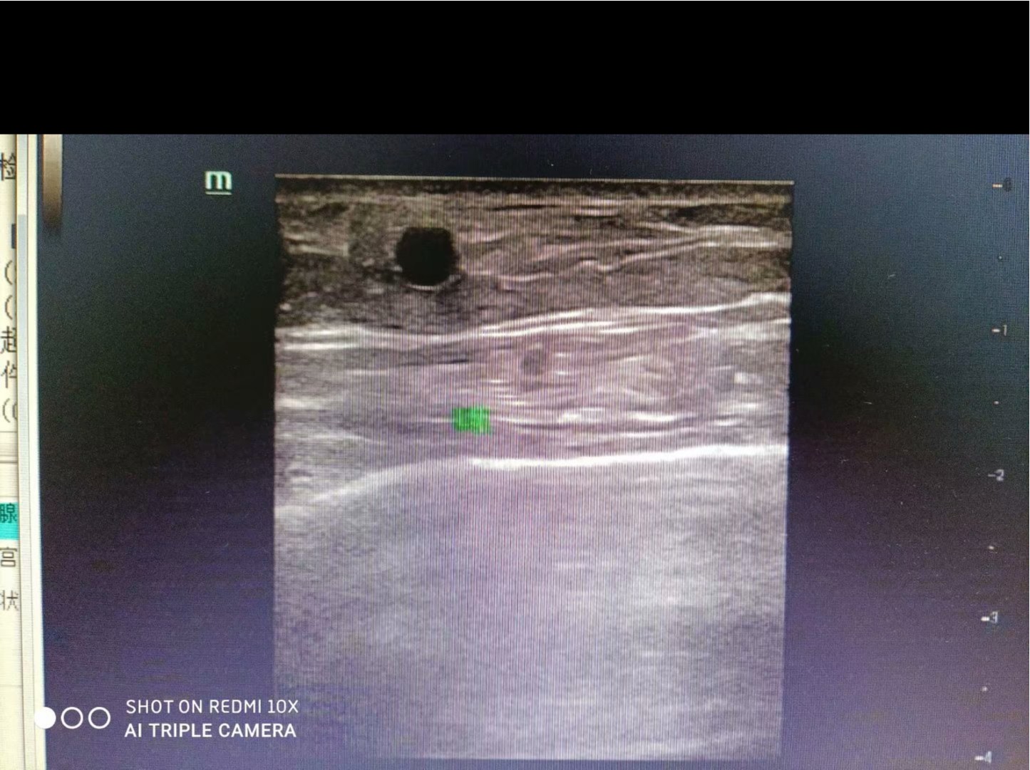 乳腺增生结节超声图像图片