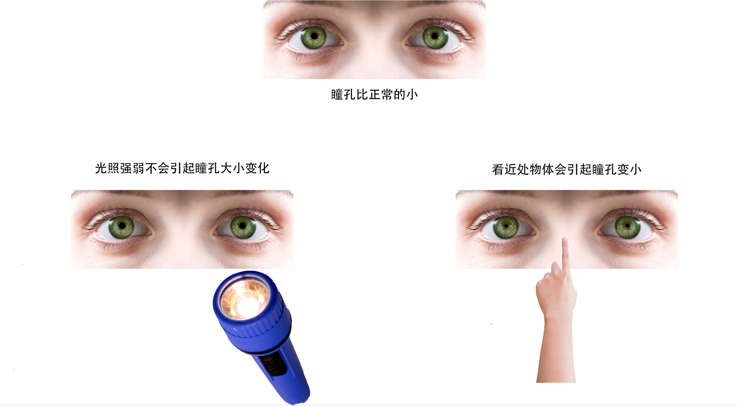 应用于红外眼科疾病检测的瞳孔定位算法